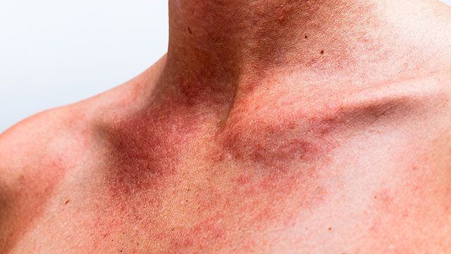 a nyakon lévő vörös foltok viszketést okoznak