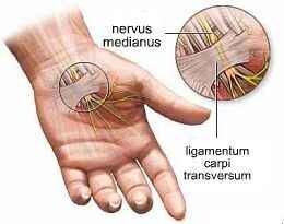 carpalis alagút szindróma műtétről vélemény