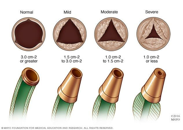Normál aortabillentyű és az aortabillentyű-szűkület fokozatai; Kép forrása: Mayo Foudation for Medical Education and Research