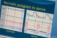 Normális polygram és apnoe