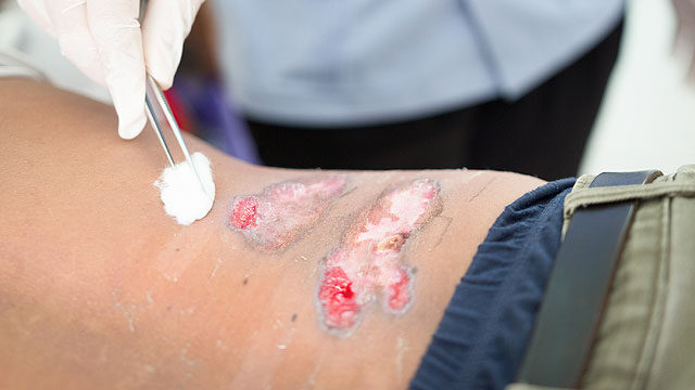 A bőr Erysipelas - az erysipelas népi jogorvoslatok kezelése - Anatómia November