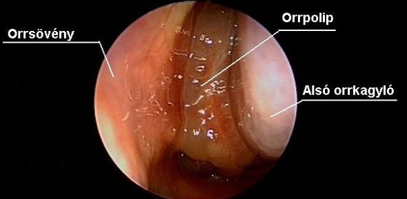Hogyan lehet megszabadulni az orr pikkelysömörétől Paraziták polipok az orrkezelésben