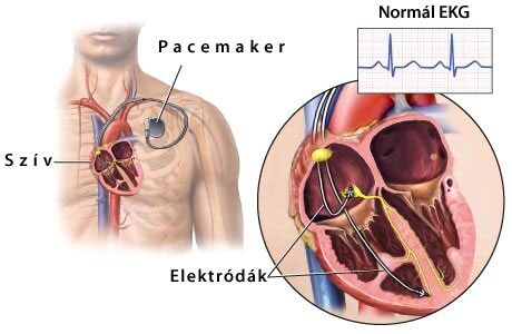 cameron egészségügyi pacemaker a szív