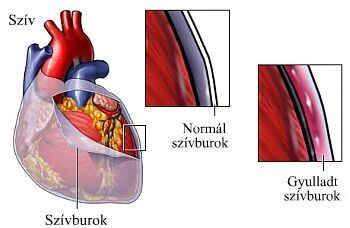 Normál és gyulladt szívburok