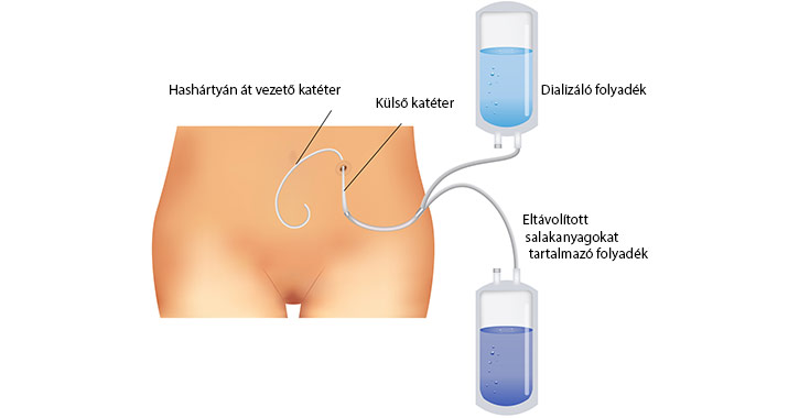 Peritoneális dialízis
