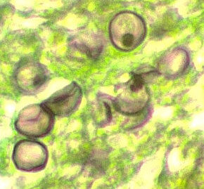 Pneumocystis carinii ciszták