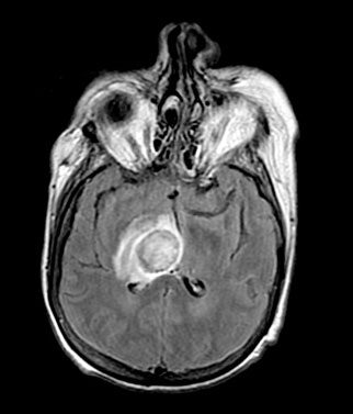 Toxoplasmosis