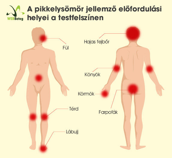 pikkelysömör táplálkozás és kezelés