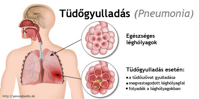 tüdőgyulladás a körömféreg miatt