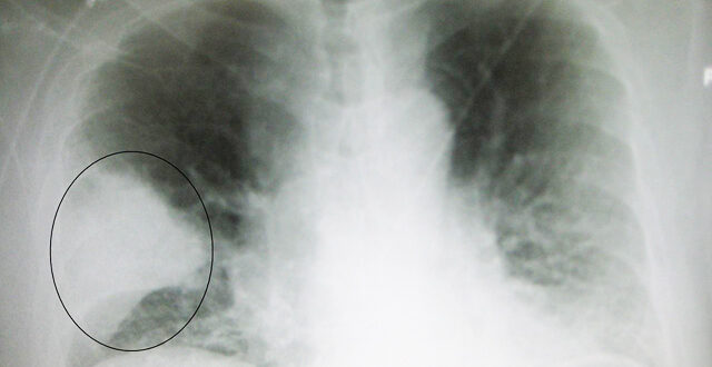 Tüdőgyulladás röntgen felvételen