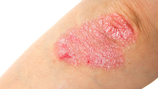 how to cure psoriasis permanently in hindi