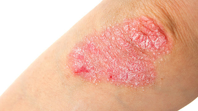 Pikkelysömör (pszoriázis, psoriasis) tünetei és kezelése