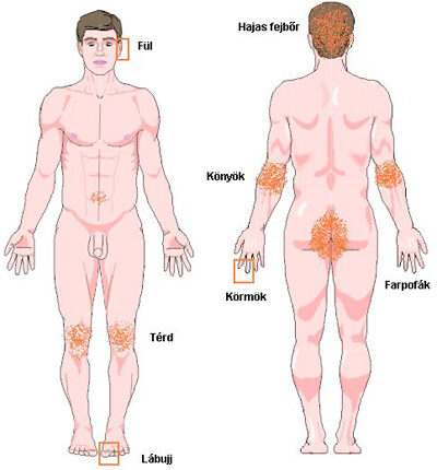 Papilloma az otthoni anális kezelésről: hatékony népi jogorvoslatok