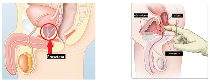 prosztata gyakorlat)
