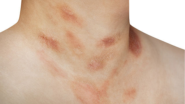 rosea bőrbetegség