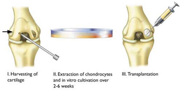 Porcregenerációs gyakorlat ortopédia és traumaműtétek számára