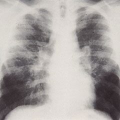 sarcoidosis ízületi fájdalom