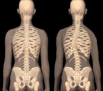 A gerincferdülés (scoliosis) tünetei és kezelése