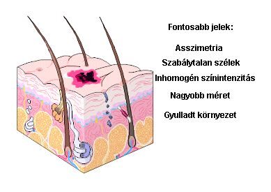 hová menjen a melanoma gyanúja esetén a látásélesség vizsgálatának jellemzői