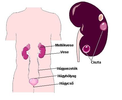 10 vese ciszták tünetei