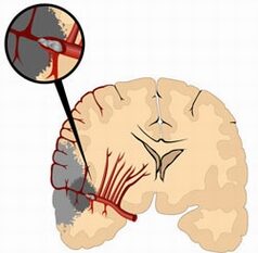 Ischeamiás stroke