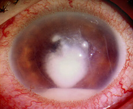 szemészeti keratitis kezelés