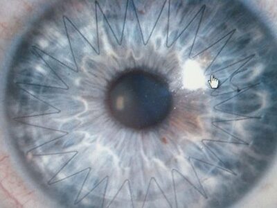 szaruhártya-transzplantáció és látás