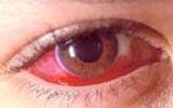 Piros a szeme?