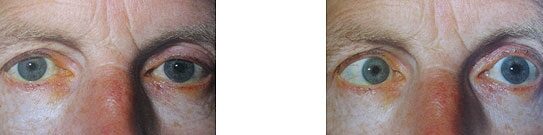Tünet: kettős látás egy szemmel nézéskor - Látás két szemmel