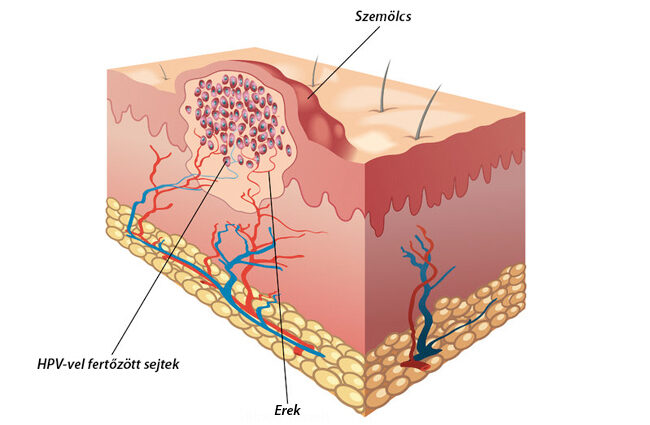 nemi szemölcsöket okoznak