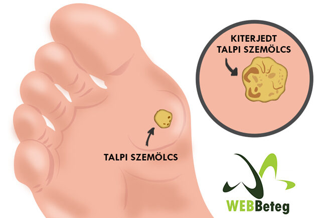 Papilloma kezeles. Mult mai mult decât documente. Papilloma kezeles Papilloma virus po polsku