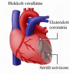 szívroham egészségügyi jelei