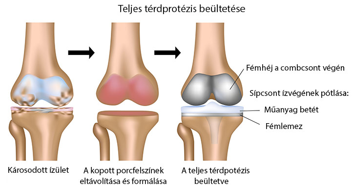 Teljes térdprotézis beültetése