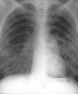 Tüdő invázió tünetei. COPD (krónikus obstriktív tüdőbetegség)