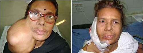 Focilabda nagyságú tumort távolítottak el indiai orvosok
