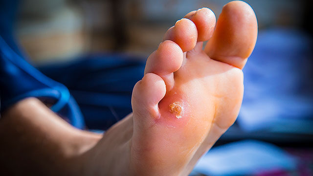 Milyen betegségekről árulkodik a láb?
