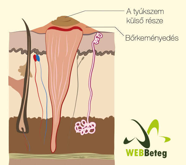 Tyúkszem