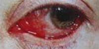 szemfenék bevérzése - A szem betegségei