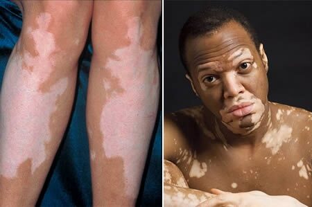 Férfi vitiligo bőrbetegséggel