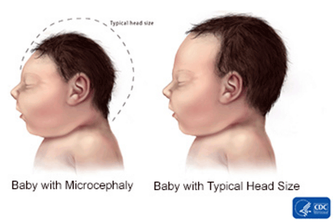 Mikrokefália - Forrás: CDC