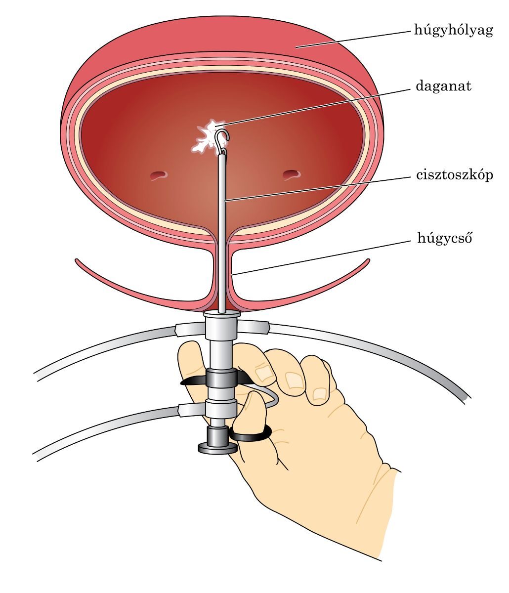 Prosztatagyulladás – Wikipédia - A prosztatagyulladás és az urethritis jelei