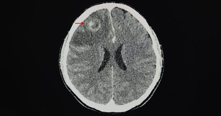 Homloklebeny-daganat kontrasztanyagos koponya-CT-felvételen