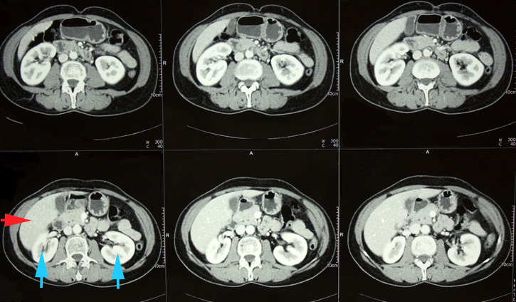Intravénás kontrasztanyag adásával készült hasi CT-felvételek