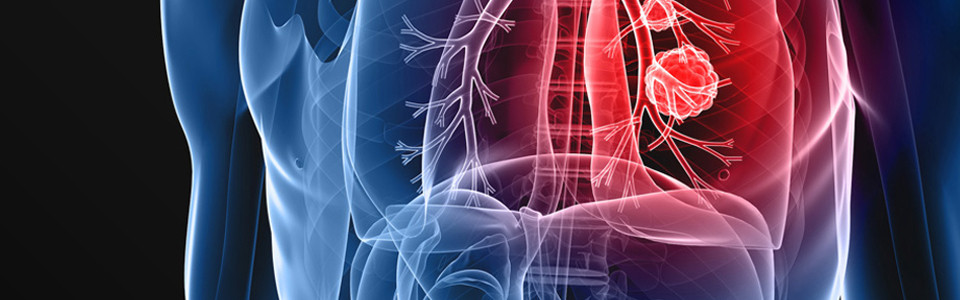Tüdőrák - Betegségek megértése: terápia cikkek