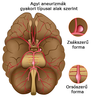 Gyi aneurizma