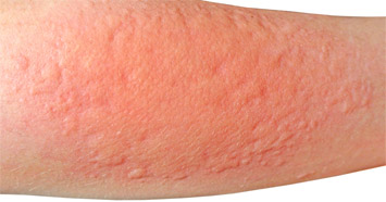 Allergiás kontakt dermatitisz