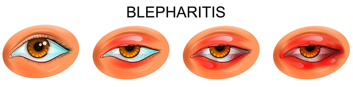 Blepharitis ábra