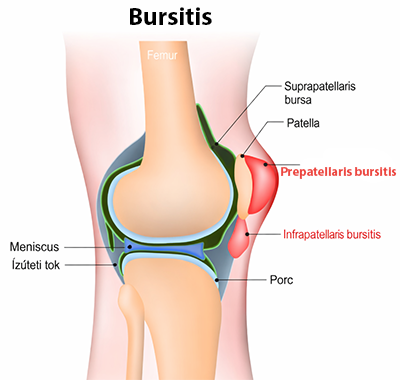 Térd bursitisek