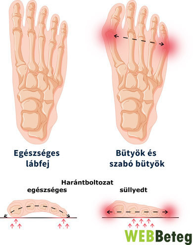 Bütyök ortopédiai okai - grafika