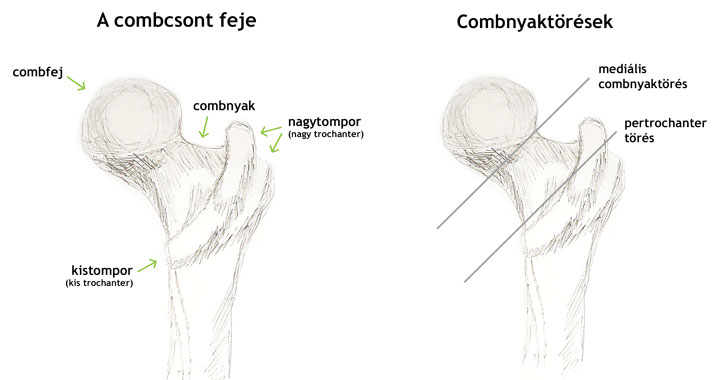 A combcsont, combnyak és combfej, illetve a combnyaktörés két típusa